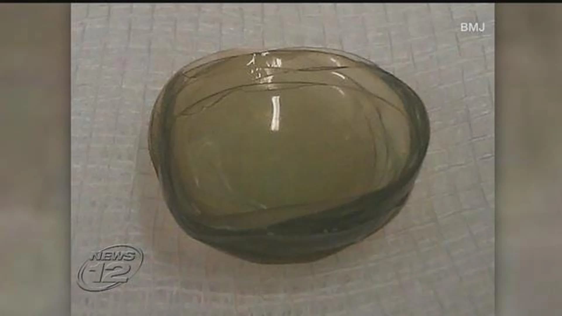 See this? Doctors find 27 contact lenses in woman's eye