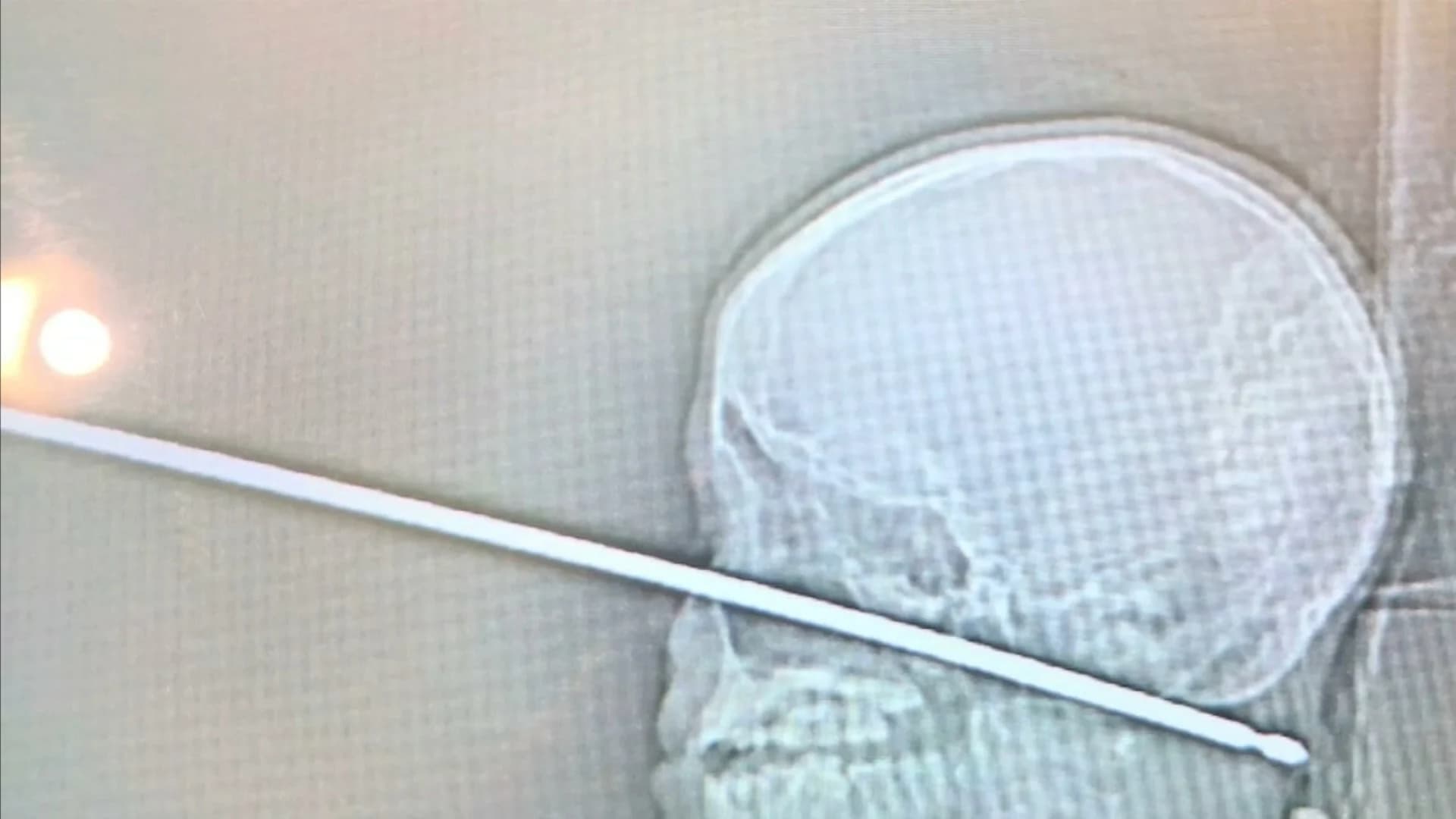 Boy survives face-first fall from tree house onto metal meat skewer